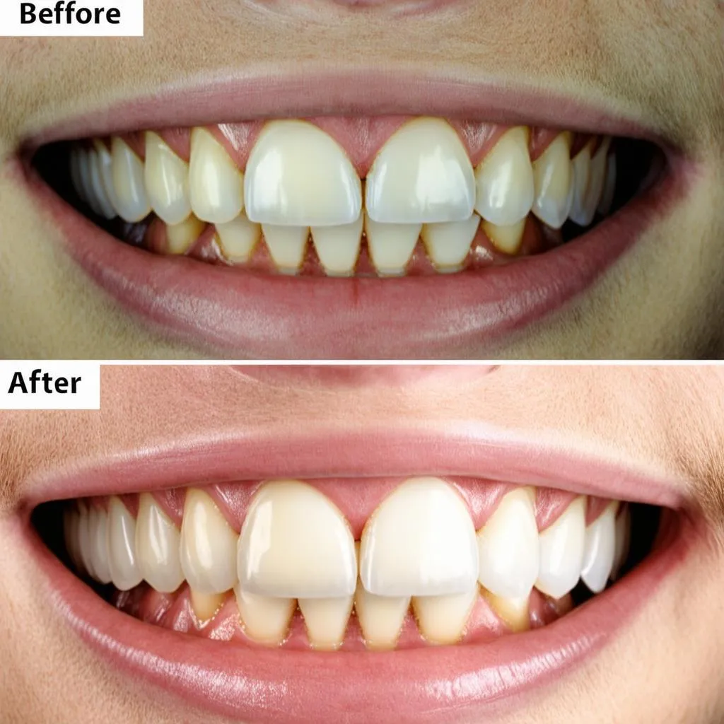 Before and After Dental Veneers